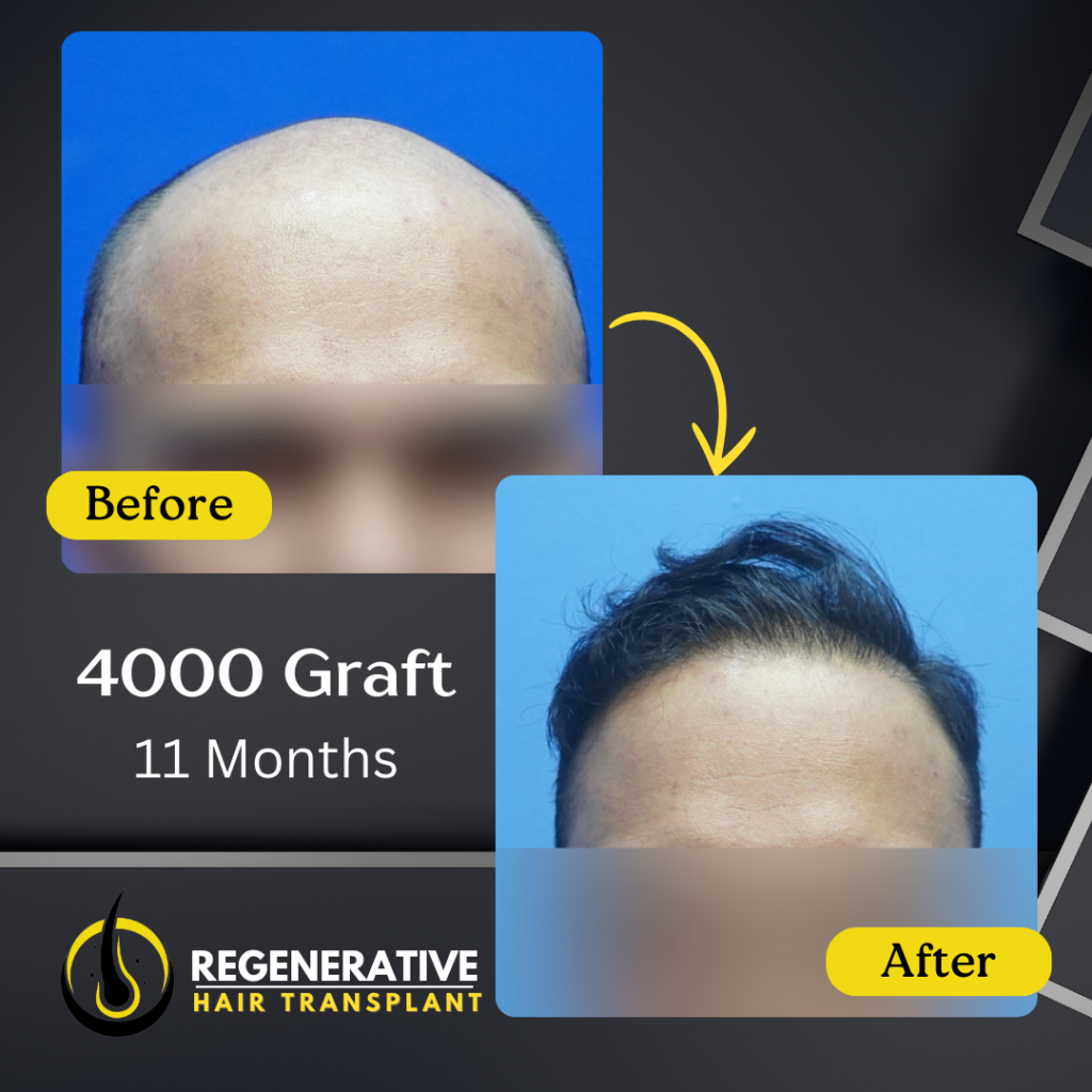 Regenerative hair Transplant Malaysia - Before After - 4000 Graft - 11 Months result