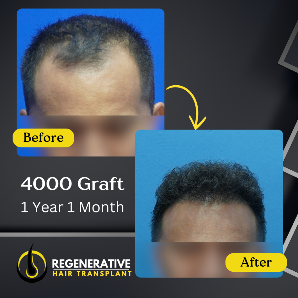 Regenerative hair Transplant Malaysia - Before After - 4000 Graft - 1 Year 1 Month result