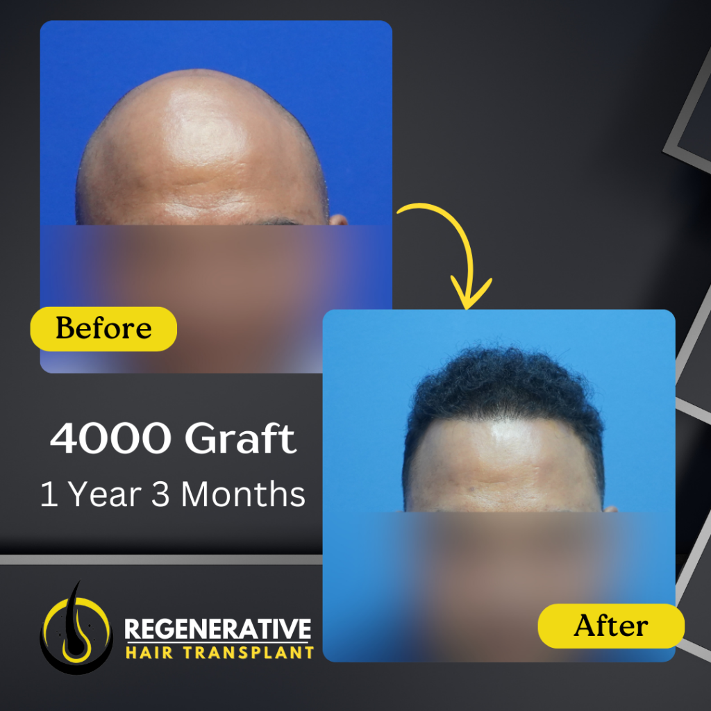 Regenerative hair Transplant Malaysia - Before After - 4000 Graft - 1 Year 3 Months result