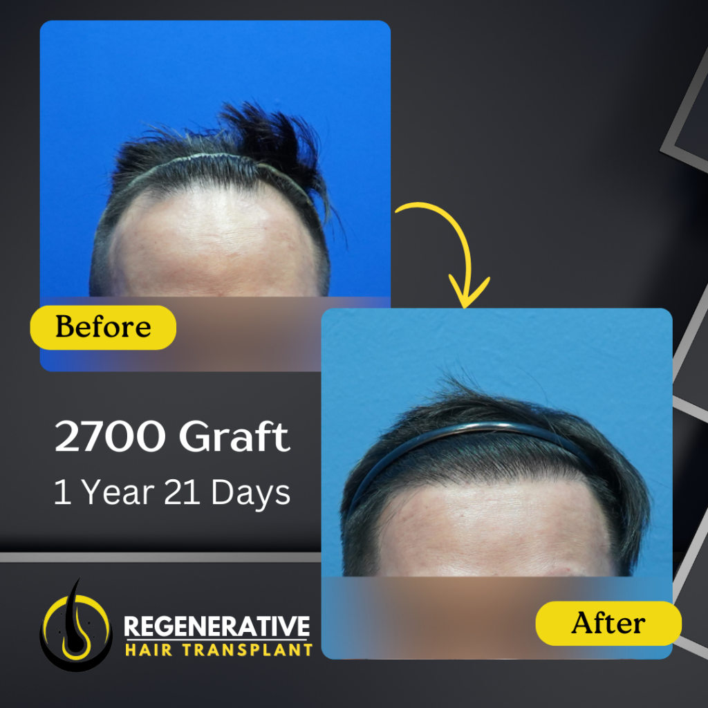 Regenerative hair Transplant Malaysia - Before After - 2700 Graft - 1 Year 21 Days result