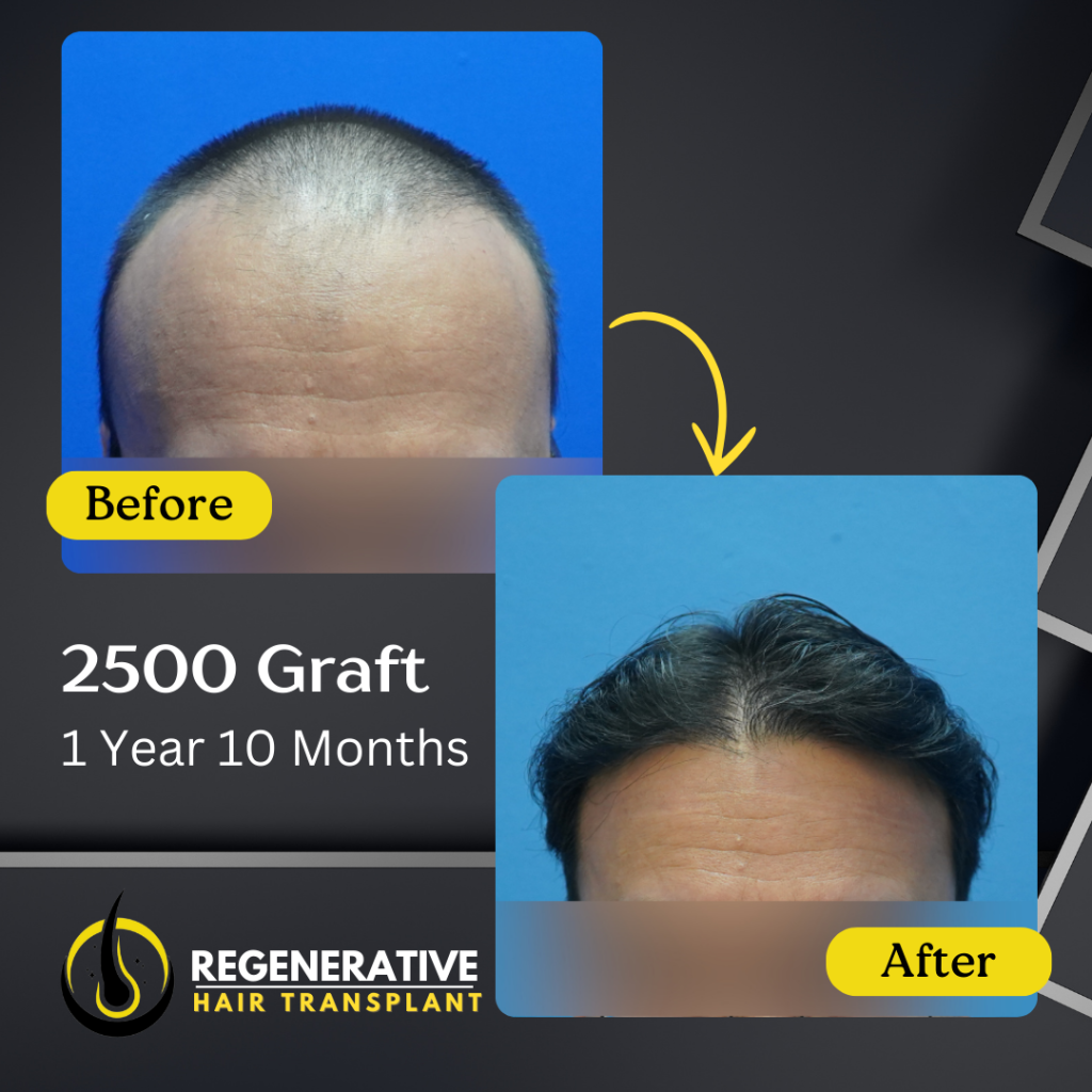 Regenerative hair Transplant Malaysia - Before After - 2500 Graft - 1 Year 10 Months result