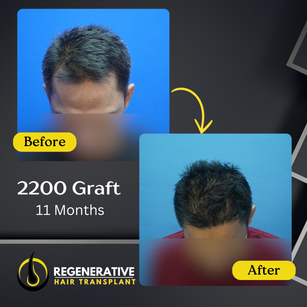 Regenerative hair Transplant Malaysia - Before After - 2200 Graft - 11 Months result
