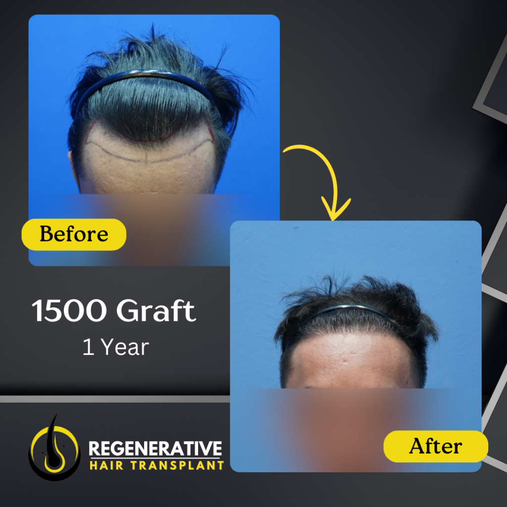 Regenerative hair Transplant Malaysia - Before After - 1500 Graft - 1 Year result