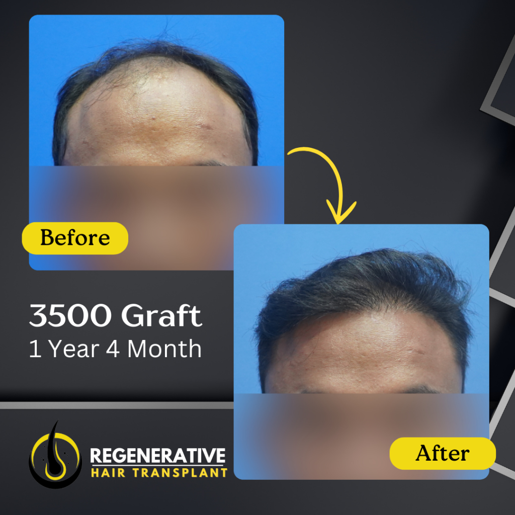 Regenerative hair Transplant Malaysia - Before After - 3500 Graft - 1 Year 4 Month result